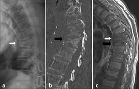 Image result for Vertebral Compression Fracture