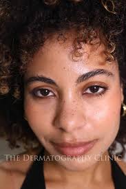 Image result for Freckled skin