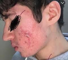 Hayatımın mahvolduğunu hissediyorum, ne yapmalıyım? : r/AcneScars