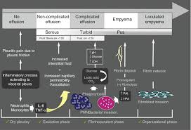 Image result for Parapneumonic Effusion
