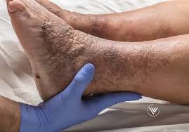 Image result for Lipodermatosclerosis