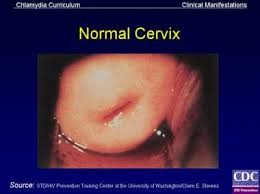 Image result for Friable Cervix