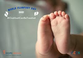 Clubfoot describes a range of foot abnormalities usually present at birth (congenital) in which your baby's foot clubfoot can be mild or severe. Clubfoot Care For Kenya Home Facebook