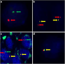 In this review, we tried to sum up the data on the rcc cell lines used. Clinicopathological Findings On 28 Cases With Xp11 2 Renal Cell Carcinoma Springerlink