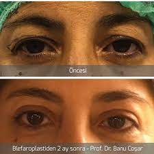 Degerli Meslektasimin Ust Goz Kapagi Estetik Ameliyati Sonrasi Blefaroplasti Ustgozkapagiestetigi Profdrbanucosar Gozdoktoru Gozhe Estetik Gozler Ust