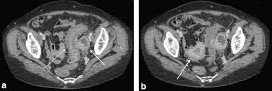 Ovarian cancer is a scary disease—it affects about 20,000 women in the u.s. Digestive Diseases Mimicking Primary Gynecological Diseases Or With Secondary Gynecological Manifestations Sciencedirect