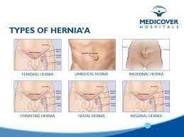 What Is A Hernia Quora