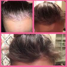 Biotin Before And After Hair Mind Blown Check Out These Before After From Megan M She Struggled With Hair Loss For What Hair Regrowth Supplements Hair Care