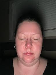 So woke up to a huge zit