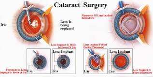 Cataract Surgery Procedure Safety Recovery Effect Cataract Surgery Eyes Eyecare Cataract Surgery Eye Surgery Lasik Eye Surgery