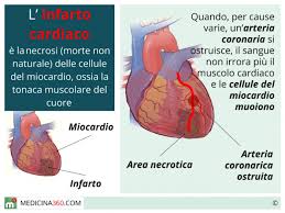Deputate alla irrorazione del cuore, le arterie coronarie, destra e sinistra, originano alla base dell'aorta ascendente. Infarto Del Miocardio Sintomi Cause Prevenzione Terapia E Conseguenze