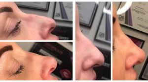 Why would it take longer to get dna paternity test results? Non Surgical Nose Job Everything You Need To Know I Heart Cosmetics