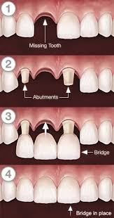 We did not find results for: 32 Dental Bridges Ideas Dental Bridge Dental Dental Crowns