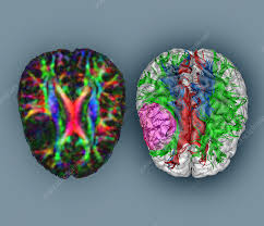 Image result for Brain Lesion