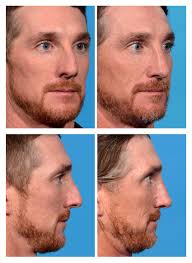Maybe you would like to learn more about one of these? Male Rhinoplasty Before And After Photos