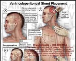 Walter S Hydrocephalus Education Blog 2018