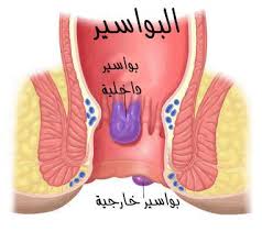 كيف تكتشف إصابتك بالشرخ الشرجي معلومات طبية ثقافة عامة ترفيه Facebook