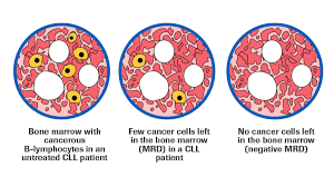 With cancer risks rising from the age of 50, he said, the test would be most important to older people, but also for younger people whose family histories might put. Roche How Decades Of Blood Cancer Research Is Paying Off