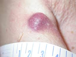 It's much more likely than common skin cancers to spread to other parts of the body if not caught early. Merkel Cell Carcinoma Dermatology Advisor
