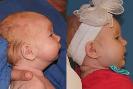 Pierre Robin Syndrome