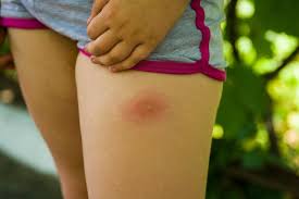 Image result for infected tick bite
