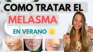 Esto se debe que está asociado con las hormonas femeninas el paño es una afectación en la piel que puede dar a cualquier persona. Melasma En Verano Se Puede Tratar Que Tratamiento Utilizar Youtube