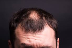 Cosmetic solutions and topical treatments are the main solutions for thinning hair on the top of the head. What Are The Causes Of Thinning Hair And The Solutions Elithair