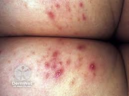 Image result for folliculitis symptoms