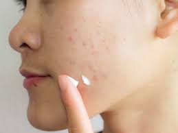 The best way to get rid of blemishes is to prevent the skin blemishes from occurring in the first place. How To Get Rid Of Acne Scars Treatments And Home Remedies