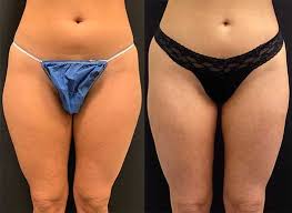 Before After Thigh Liposuction Neinstein Plastic Surgery