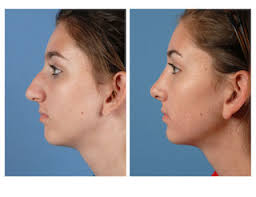 We bring you the same digital imaging technology that surgeons use to visualize plastic surgery results — all in a super. Rhinoplasty What To Expect Before And After A Nose Job Plastic Surgery Ut Southwestern Medical Center
