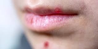 What causes acne on upper lip? Pimple On Lip Causes Treatment And Prevention