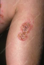 Image result for Impetigo