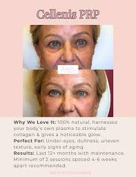 ✨ Which Biostimulator Is Best for You? 💉 Not all injectables are fillers  and not all results should look instant. Biostimulators are injectables  that stimulate your body's own collagen production, gradually improving