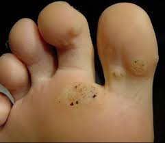 Calo Seco No Dedo Do Pé Thumb Trate O Olho De Peixe Com Remedios Caseiros Verruga Plantar Ervas Medicinais Cancer De Colo Do Utero