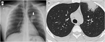 Current state of knowledge on aetiology, diagnosis, management and therapy of myocarditis. Acute Myocarditis Associated With Covid 19 Infection The American Journal Of Emergency Medicine