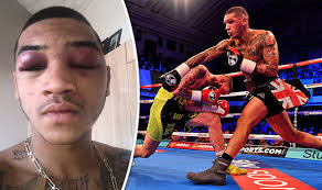 Jun 14, 2021 · eddie hearn claims conor benn is 'a future global star' and insists son of british icon nigel will benefit from new dazn deal by fighting for the world title before 2023 Boxer Conor Benn Reveals Gruesome Injuries After Gutsy Win Over Cedrick Peynaud Boxing Sport Express Co Uk