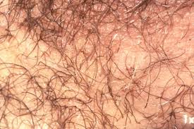 Image result for pubic lice symptoms