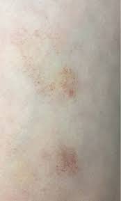 The term purpura is usually used to refer to a skin rash in which small spots of blood appear on the skin. A 9 Year Old Girl With Petechial Patches On Her Legs
