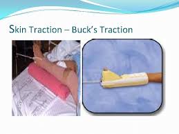 Cpt code bucks traction can offer you many choices to save money thanks to 16 active results. West Coast University Musculoskeletal System Disorder Degenerative Joint
