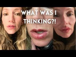 My Lip Injections Experience! What to know before plastic surgery.