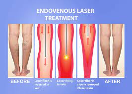 Endovenous Treatment Of Vein Disease The Vein Institute