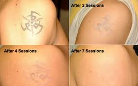 Sometimes, complete removal of a tattoo can take one or two years, with treatments occurring every 6, 8, or 12 weeks. Permanent Laser Tattoo Removal In Dubai Laser Skin Care Clinic