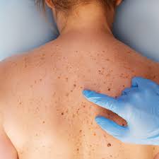 If you see any suspicious skin lesion, especially one that is new or changed in size, contact your healthcare provider. Vitamin B3 Nicotinamide Tablets Spot Check Clinic