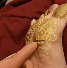 From front to back, these layers are. Hornhaut Extrem Dieses Ekel Video Ist Nichts Fur Schwache Nerven