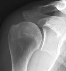 Image result for Shoulder XRay
