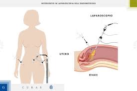Specialists recommend considering these five strategies. Laparoscopia Per L Endometriosi Gemelli Curae