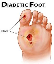 Diabetic foot care near me. Diabetic Foot Care St Catharines Ontario Canadian Foot Clinic Orthotic Centre