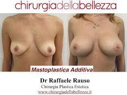 Foto Mastoplastica Additiva Napoli | Dr. Raffaele Rauso
