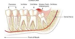 Frandsen Dental Quality Dental Care For All Ages And Smiles Wisdom Teeth Wisdom Teeth Removal Wisdom Tooth Extraction